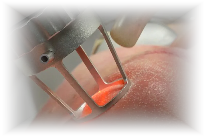 A fractional CO2 laser handpiece held against the skin of a cheek, the aiming beam glowing red beneath the tip and the treated skin visibly damp.