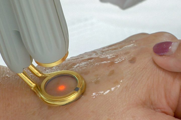 A laser handpiece with a gold ring aperture held against the back of a hand, treating age spots, the skin beneath it wet with coupling gel.